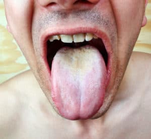 Candidiasis-Candida Overgrowth on Tongue